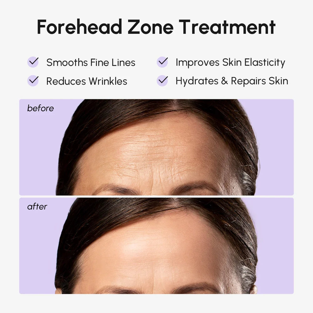 Maree anti-wrinkle forehead patches applied to smooth forehead skin, reducing the appearance of fine lines and wrinkles.